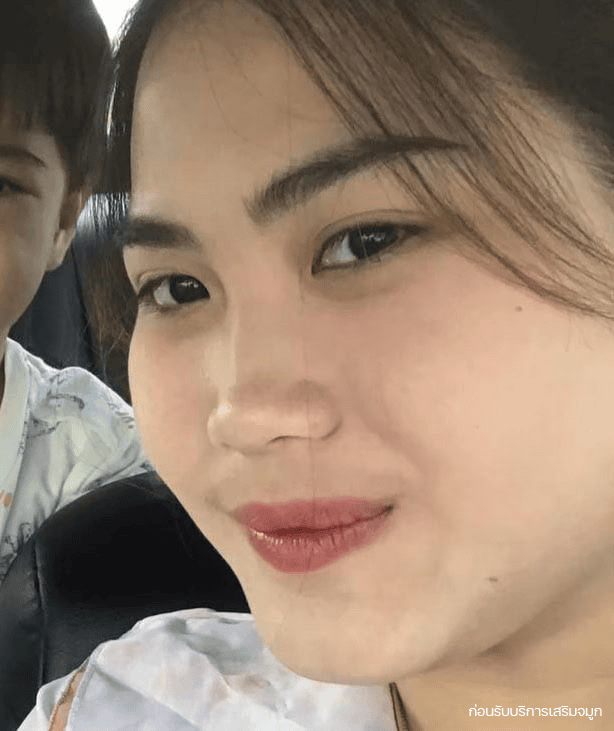 ภาพก่อนเสริมจมูกของคุณจอย มุมด้านหน้า