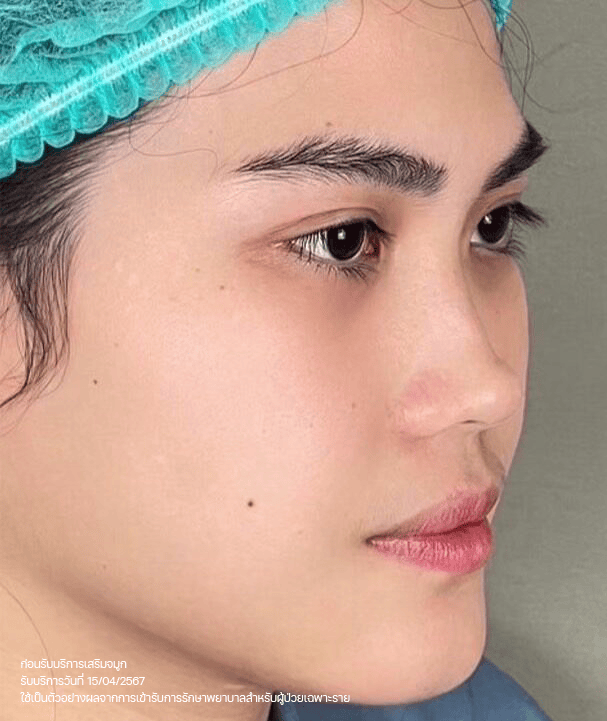 ภาพก่อนเสริมจมูกของคุณจอย มุมด้านข้าง