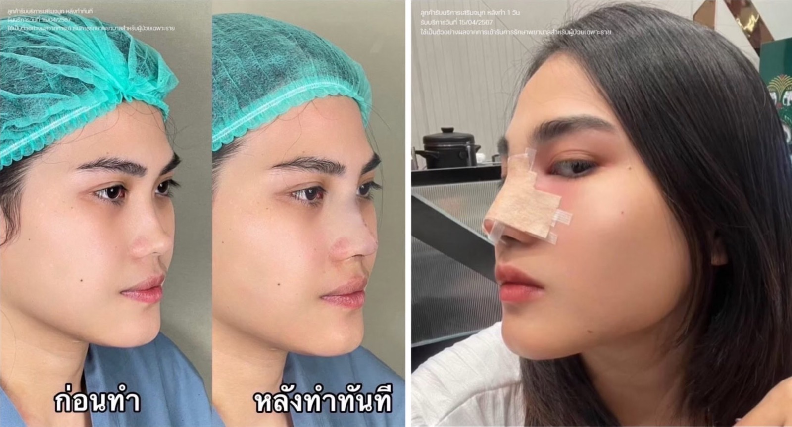 คุณจอยหลังเสริมจมูกที่ ดิ อีสท์ คลินิก