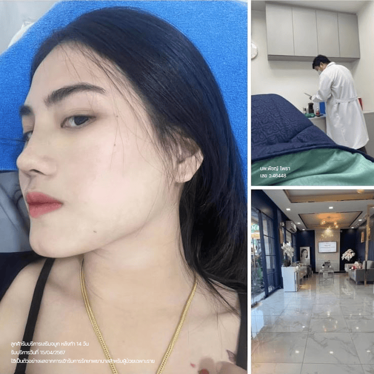 ผลลัพธ์เสริมจมูกของคุณจอยหลังผ่าตัด 14 วัน