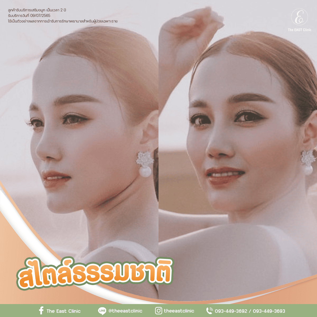 ตัวอย่างจมูกทรงสไตล์ธรรมชาติ