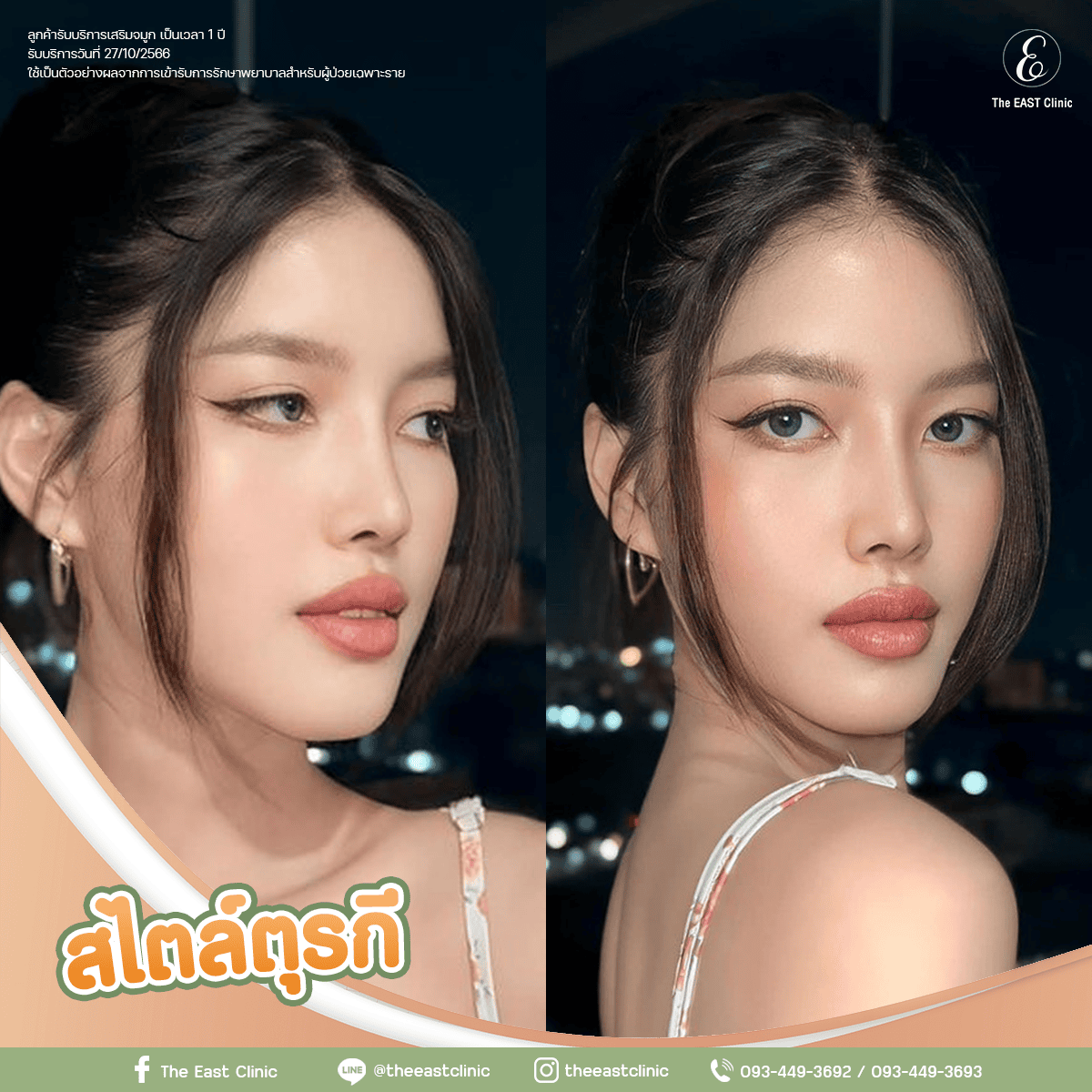 ตัวอย่างจมูกทรงสไตล์ตุรกี