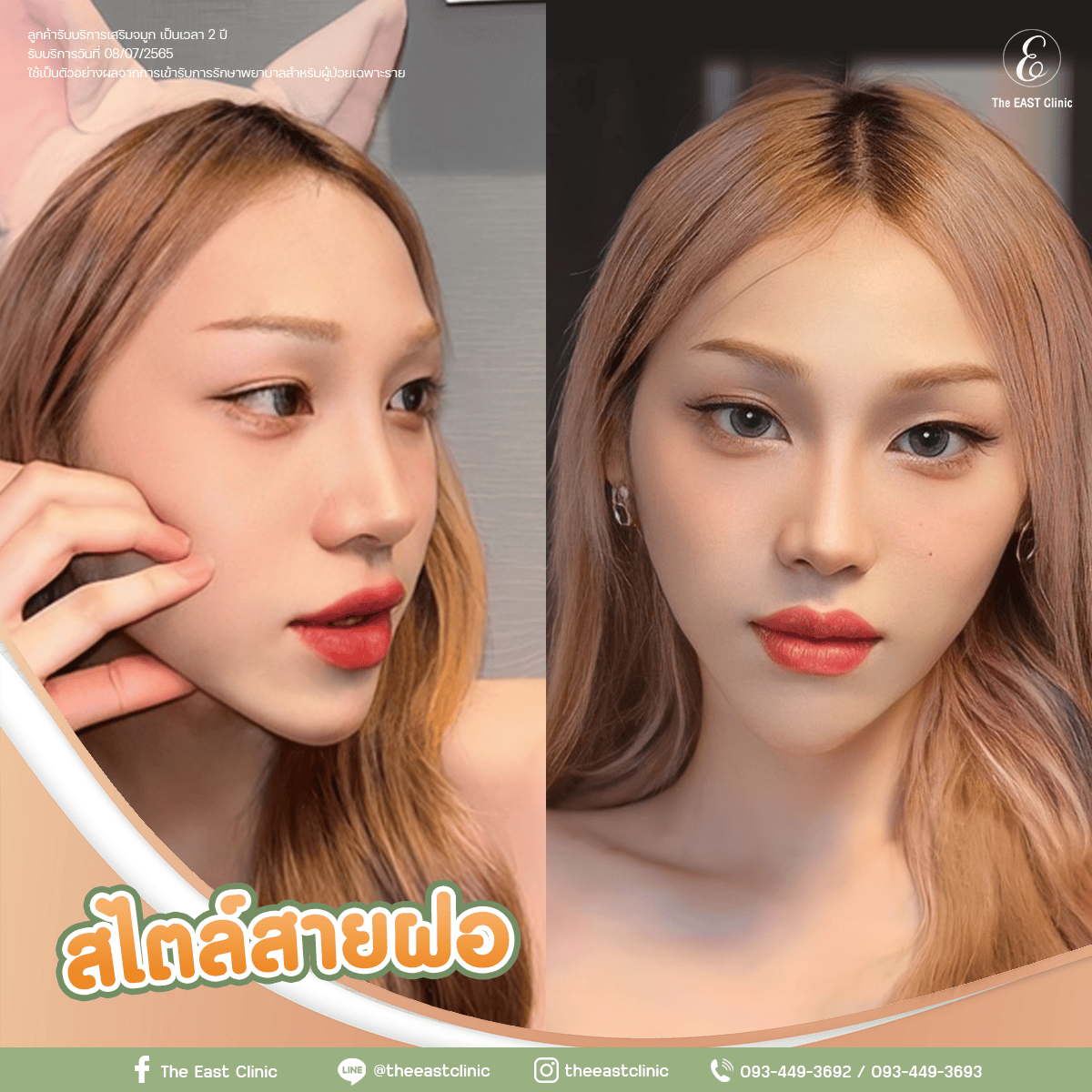 ตัวอย่างจมูกทรงสไตล์สายฝอ
