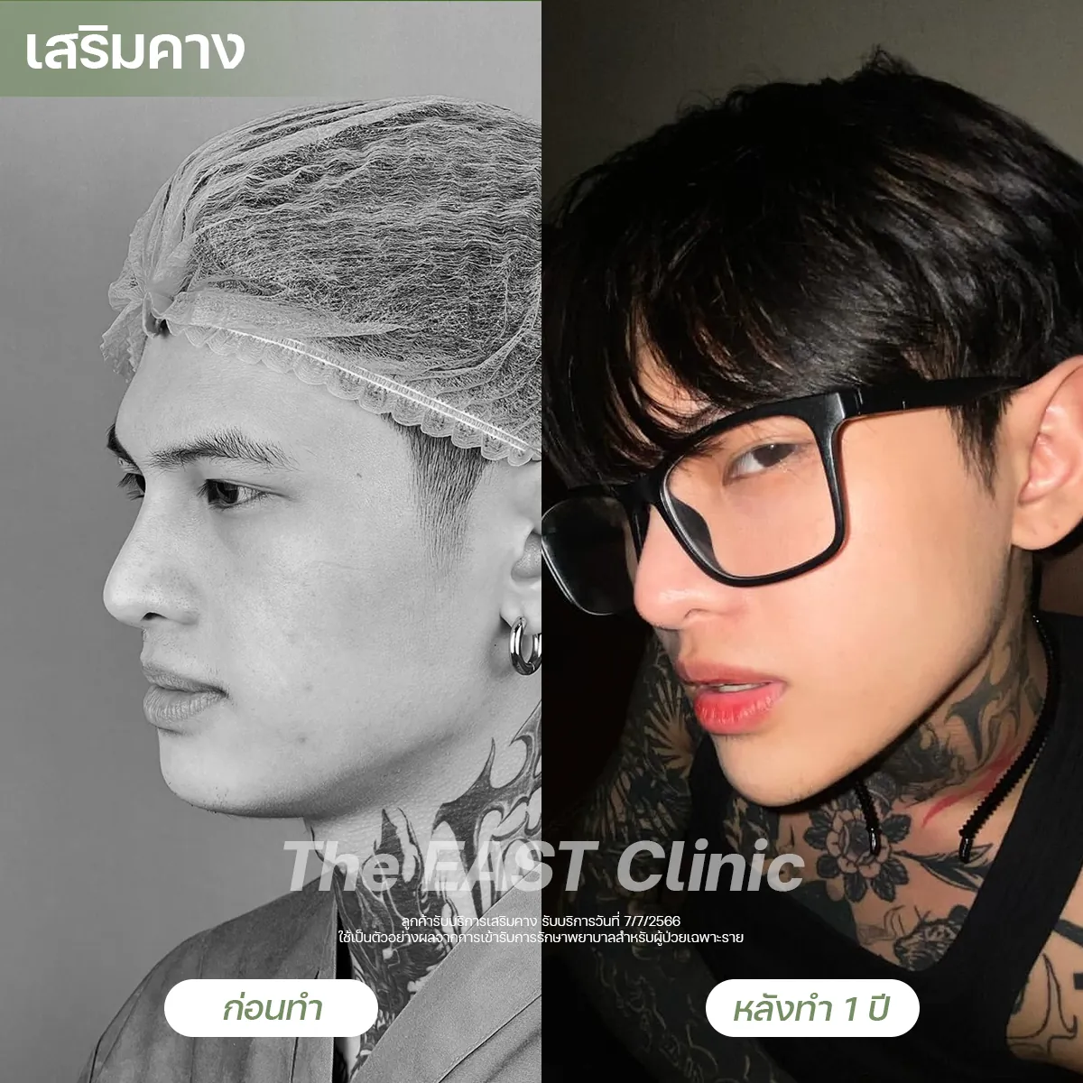 ภาพก่อนและหลังเสริมคางที่ ดิ อีสท์ คลินิก (1/5)