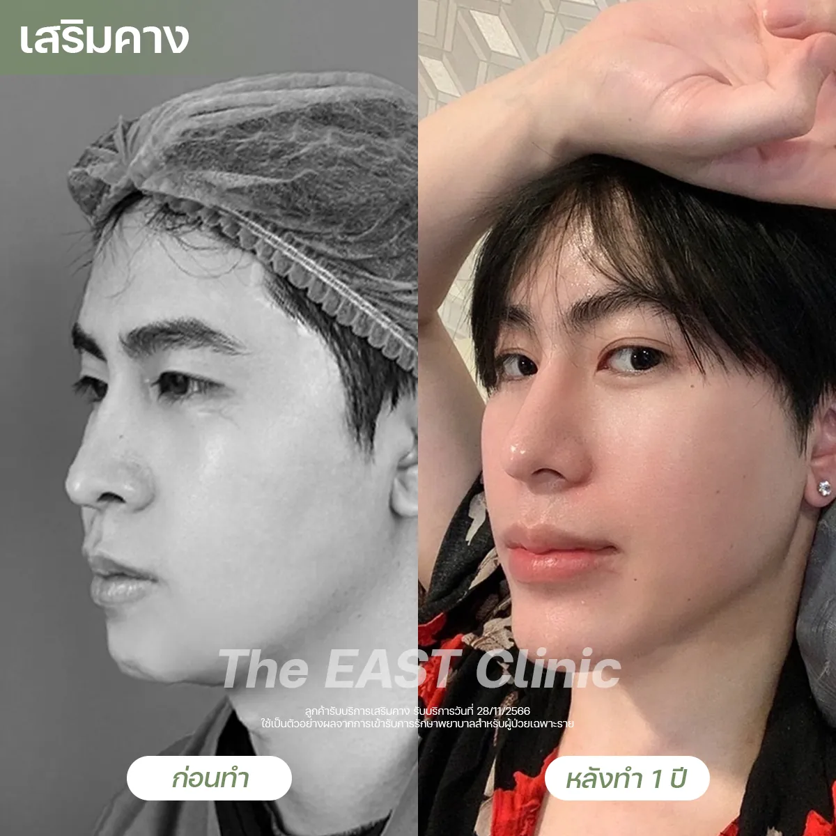ภาพก่อนและหลังเสริมคางที่ ดิ อีสท์ คลินิก (3/5)