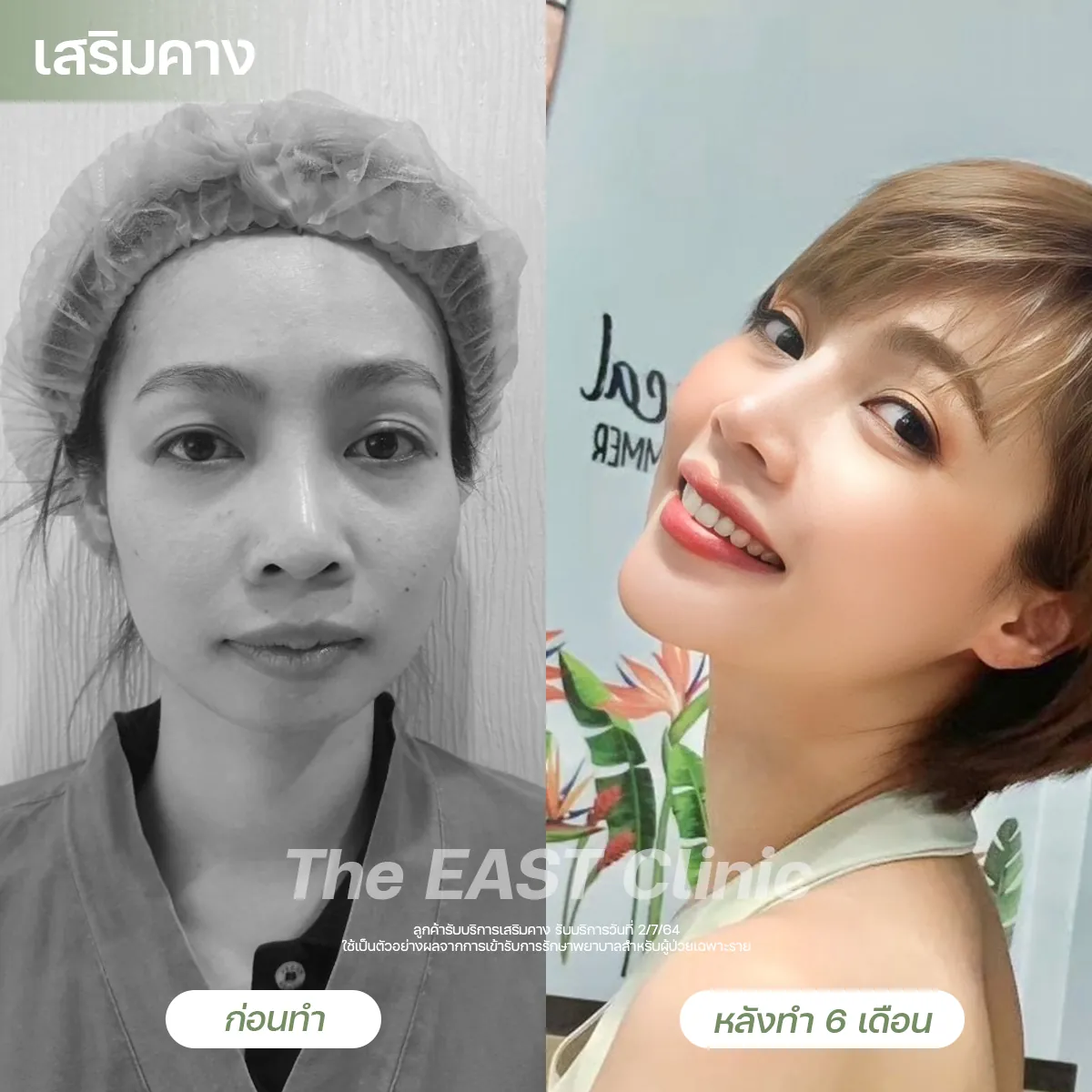 ภาพก่อนและหลังเสริมคางที่ ดิ อีสท์ คลินิก (4/5)