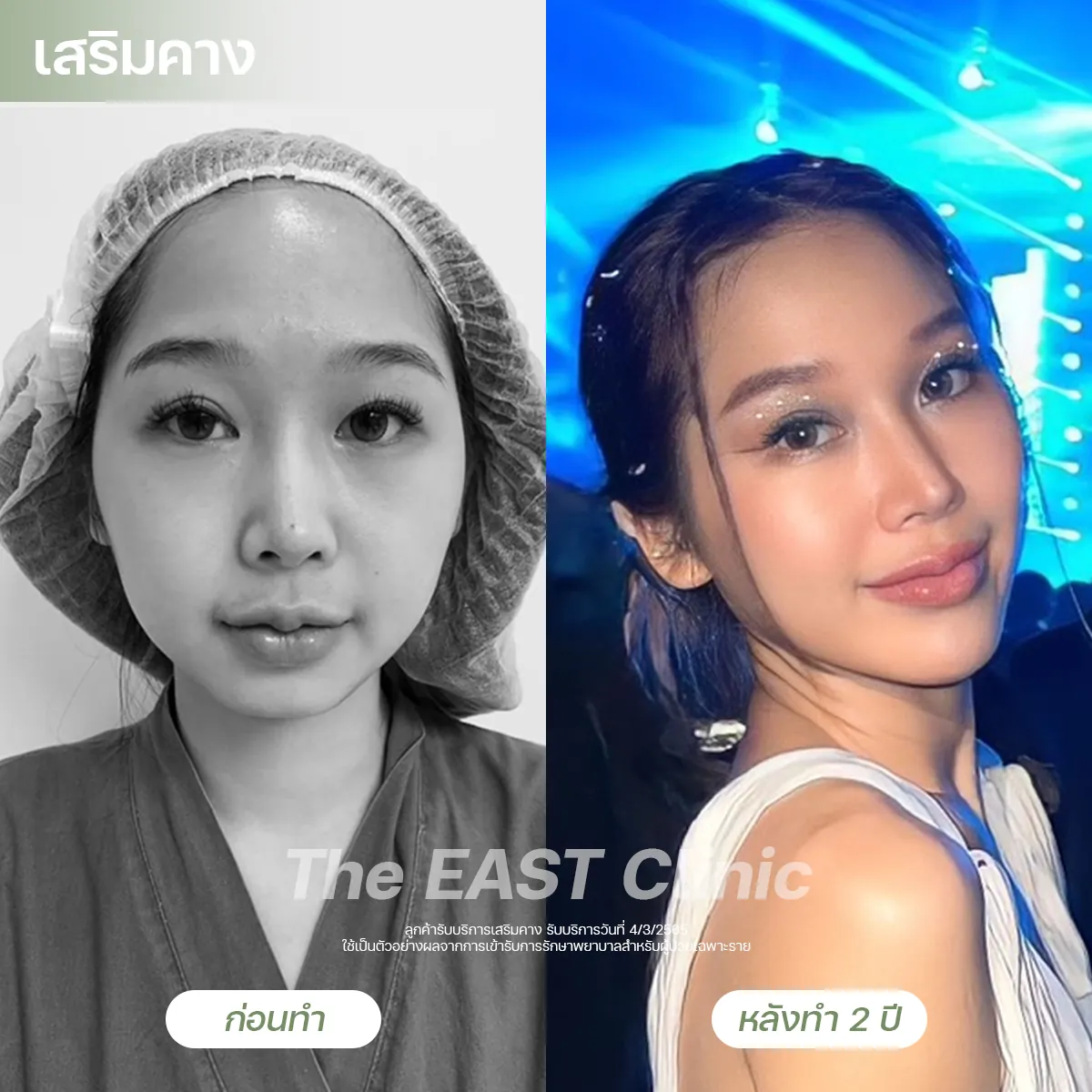 ภาพก่อนและหลังเสริมคางที่ ดิ อีสท์ คลินิก (5/5)