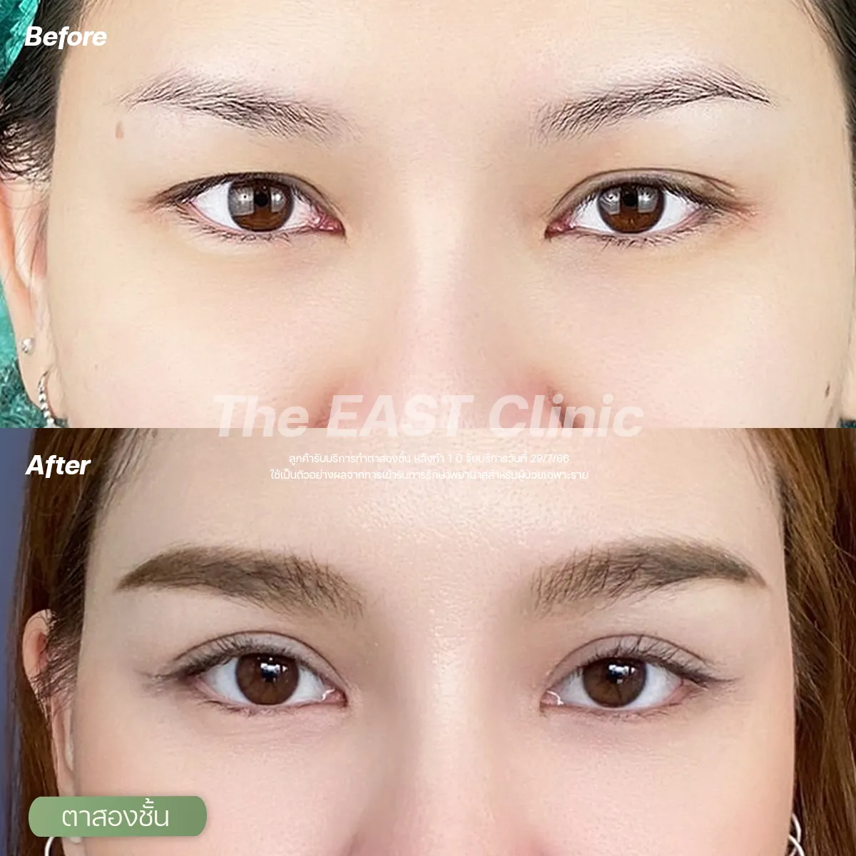 ภาพก่อนและหลังทำตาสองชั้นที่ ดิ อีสท์ คลินิก (1/5)