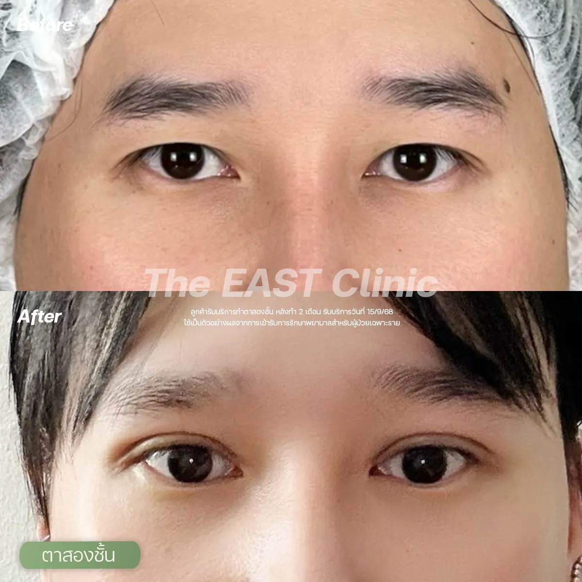 ภาพก่อนและหลังทำตาสองชั้นที่ ดิ อีสท์ คลินิก (5/5)
