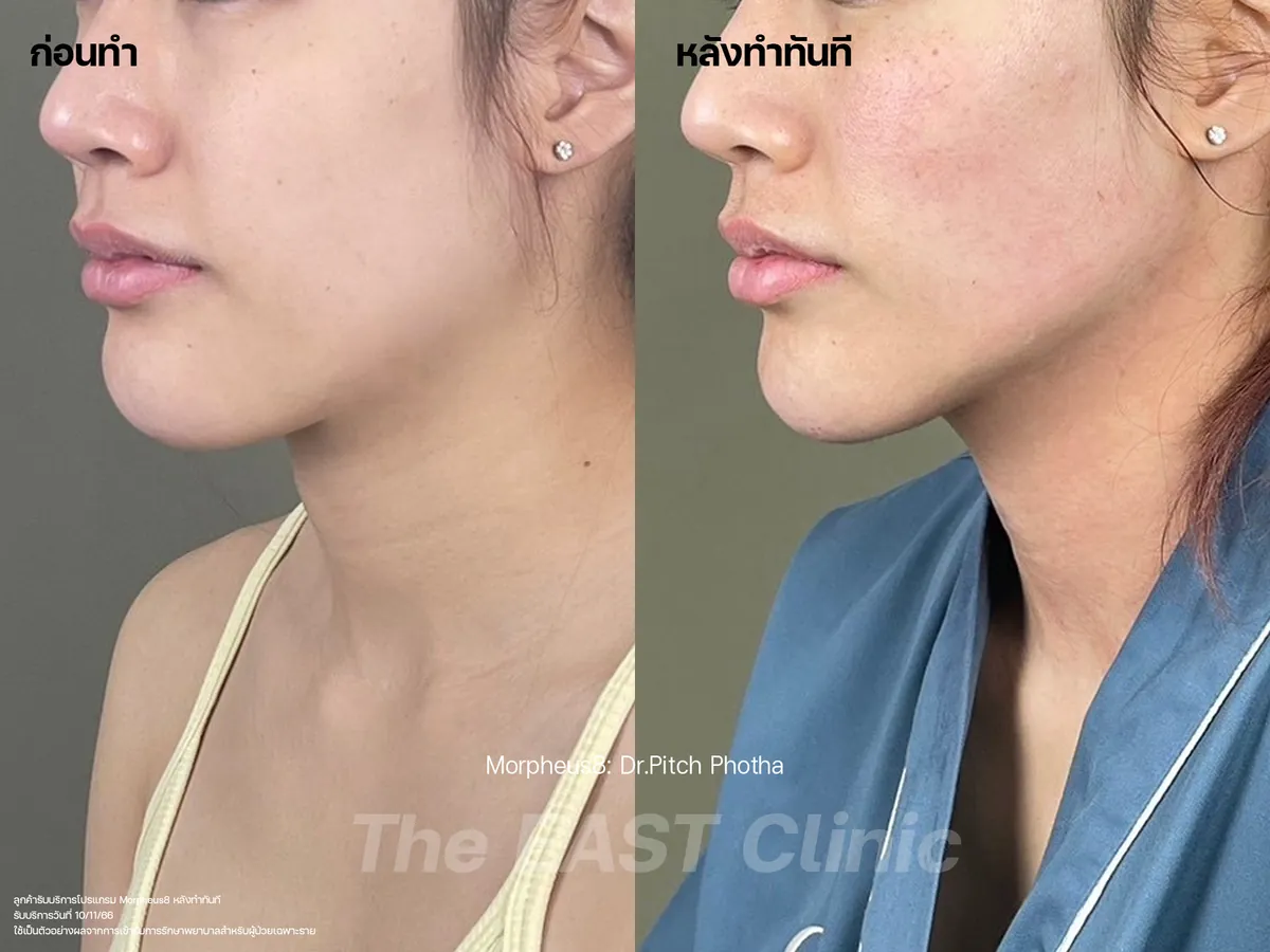 ภาพก่อนและหลังโปรแกรมยกกระชับ Morpheus8 ที่ ดิ อีสท์ คลินิก (2/5)