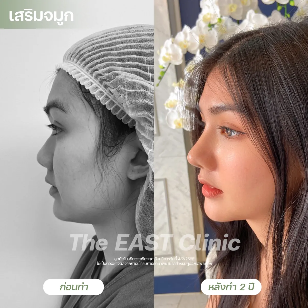 ภาพก่อนและหลังเสริมจมูกที่ ดิ อีสท์ คลินิก (1/5)