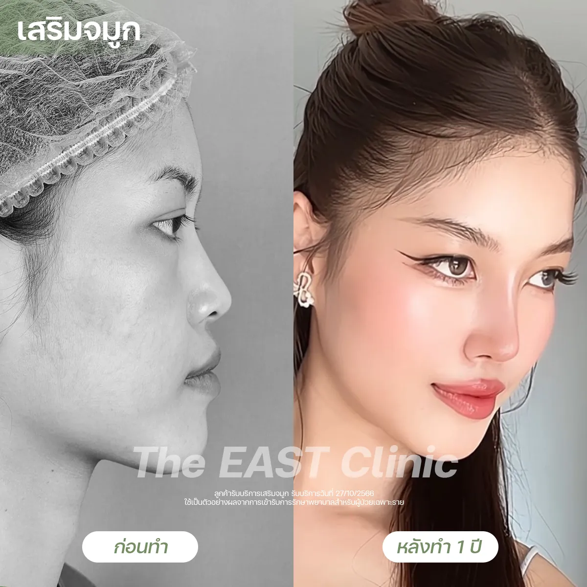ภาพก่อนและหลังเสริมจมูกที่ ดิ อีสท์ คลินิก (2/5)