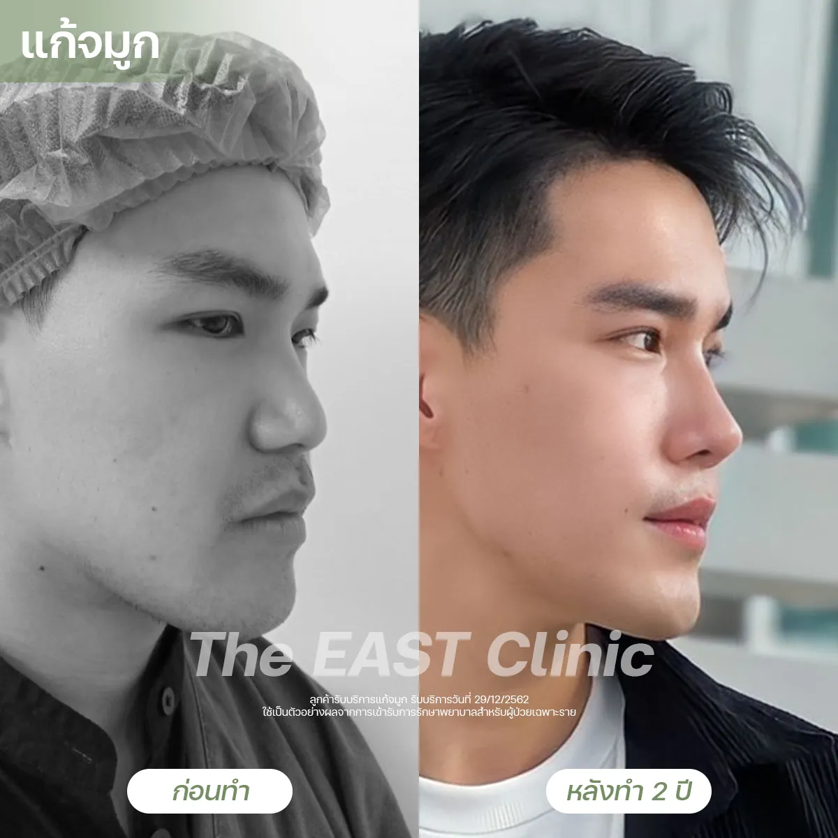 ภาพก่อนและหลังเสริมจมูกที่ ดิ อีสท์ คลินิก (3/5)