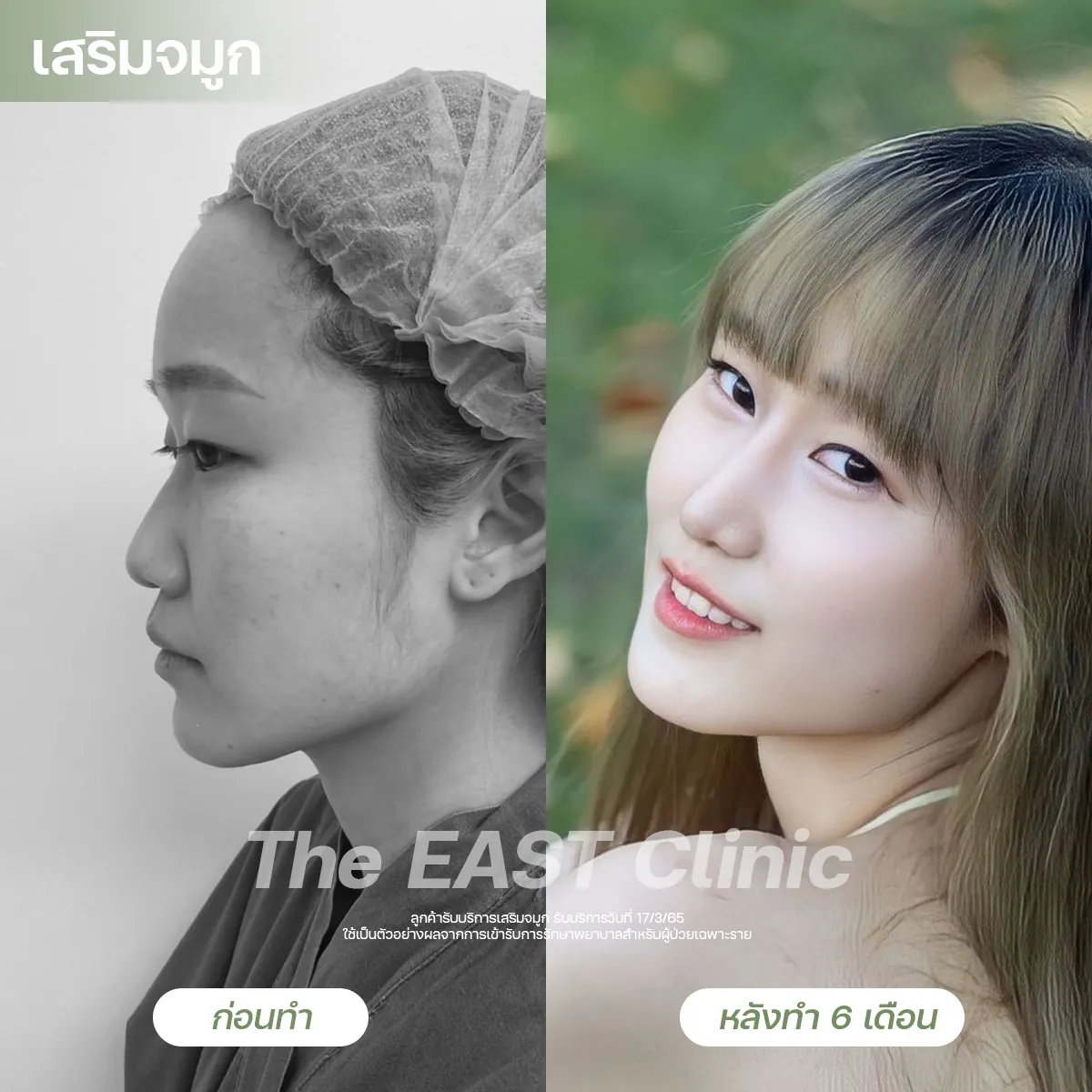 ภาพก่อนและหลังเสริมจมูกที่ ดิ อีสท์ คลินิก (4/5)