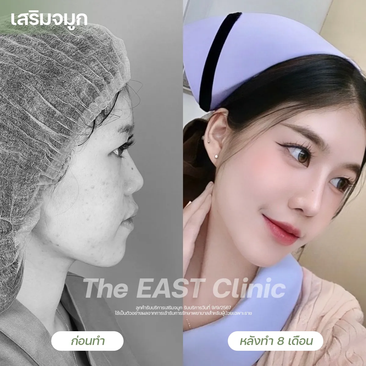 ภาพก่อนและหลังเสริมจมูกที่ ดิ อีสท์ คลินิก (5/5)