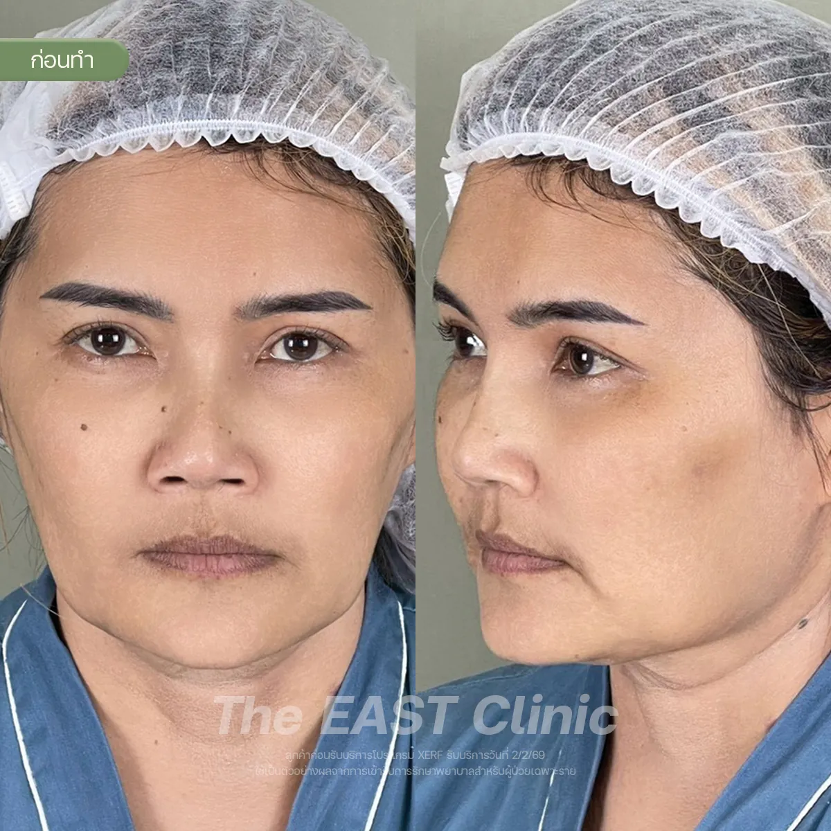 ภาพก่อนและหลังโปรแกรมยกกระชับ XERF ที่ ดิ อีสท์ คลินิก (1/3)
