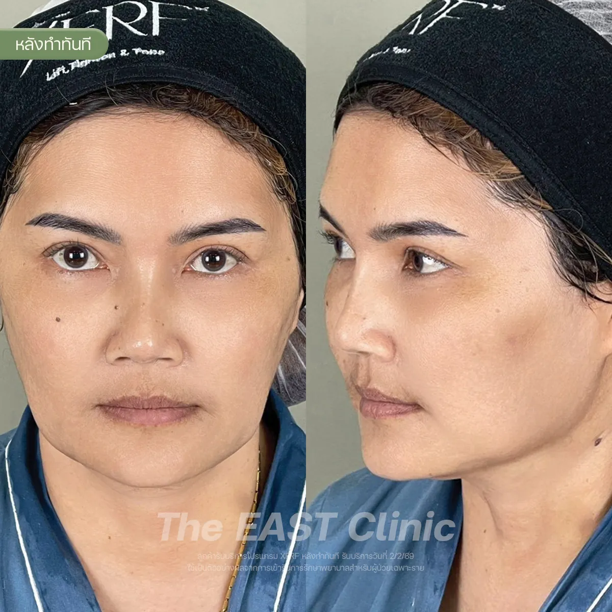 ภาพก่อนและหลังโปรแกรมยกกระชับ XERF ที่ ดิ อีสท์ คลินิก (2/3)