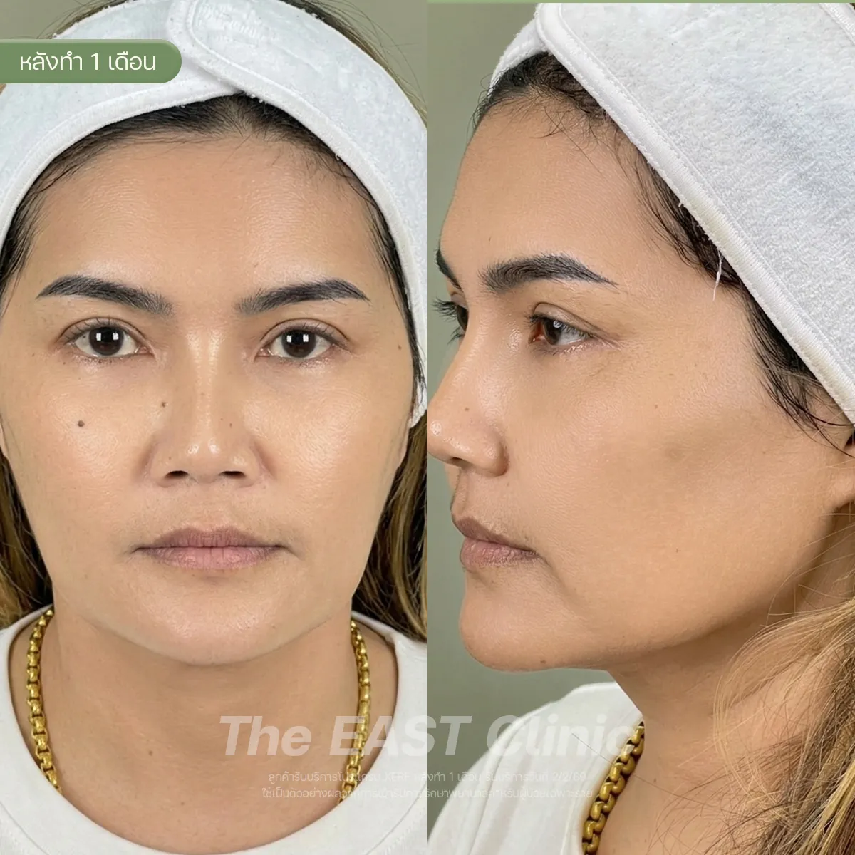 ภาพก่อนและหลังโปรแกรมยกกระชับ XERF ที่ ดิ อีสท์ คลินิก (3/3)